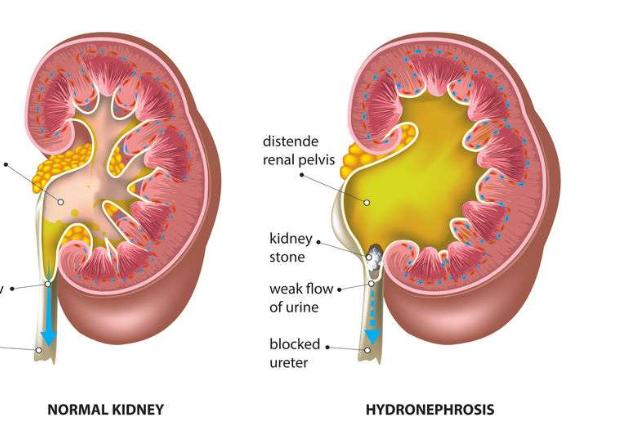 肾病|身体有3个表现，提醒你肾脏已经出现了问题，再不注意就晚了