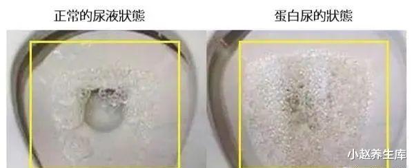 尿毒症:一家三口查出尿毒症,需终身透析,提醒:2件事惹的祸,不知克制