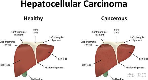 「肝癌」医生提醒：肝癌的“罪魁祸首”是它，比抽烟喝酒还可怕，要注意