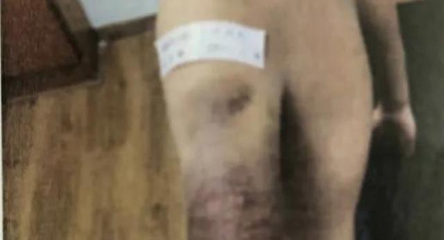 【】错一题打50下！小学生被情侣打到皮开肉绽，亲妈人在外地浑然不知