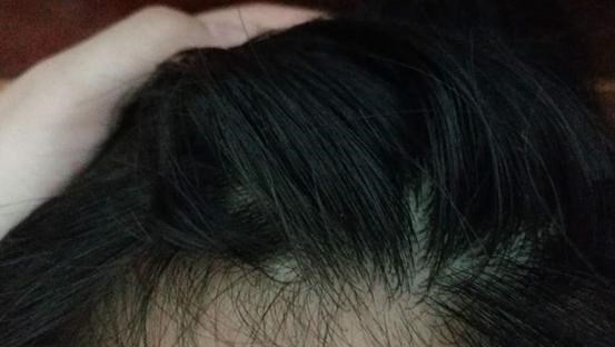 肝脏|肝硬化最怕“一种水”,若你爱喝,冲走肝内毒素,修复肝细胞!