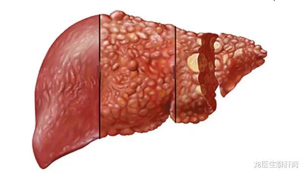 肝癌|如果肝硬化变肝癌了，身体会发出什么“信号”吗？听听医生怎么说