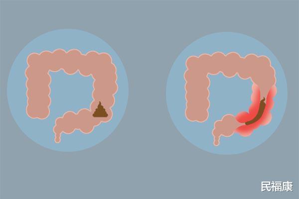 【胆囊】胆囊对人体有什么作用？摘掉胆囊的人，都不长寿，是真的吗？