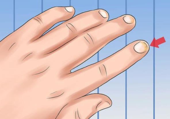 「疾病」指甲出现这5种情况,当心是体内疾病的信号,很多人却视而不见!