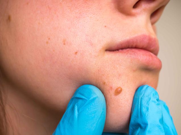 蜘蛛痣|体内有癌,痣先知?医生告诫:这3种痣癌变风险大,尤其要当心