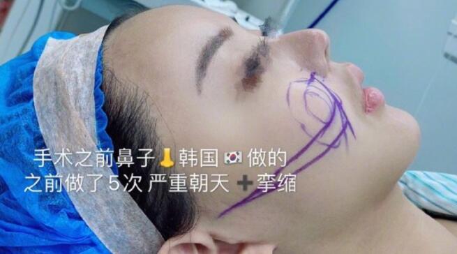 韩安冉|21岁韩安冉第35次整容整出木偶尖鼻，香港网友：再整要变僵尸