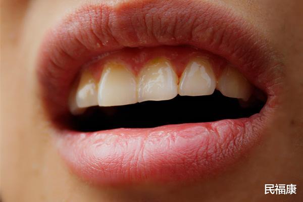 【肝功能】肝不好的人，嘴巴会发生什么变化？若中招，及时去检查肝功能