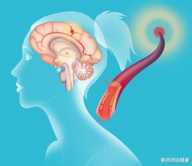 脑供血不足|50岁后进入生命高危期,减少脑供血不足风险,8个坏习惯最好改掉