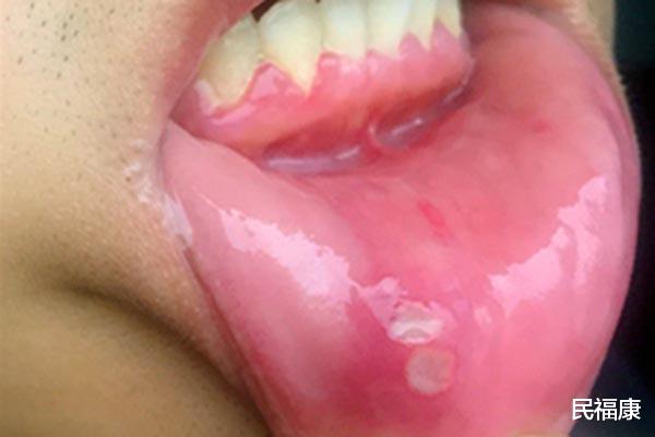 疾病|每3秒就有1人被癌症夺命，提醒：4种小毛病，拖着不管或会恶变