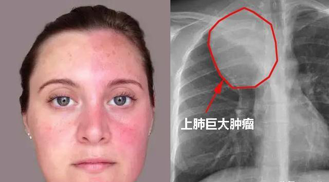 肺癌：肺癌可能出现在外表的一些症状，有些一看就知道肺出了问题