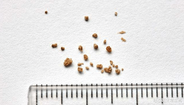 「肾结石」是吃太荤会容易患肾结石还是吃太素?看看自己吃对了吗?