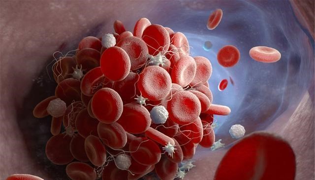 [熬夜]血栓的“元凶”被找到，忠告：若不想给血管添堵，4事尽早改之