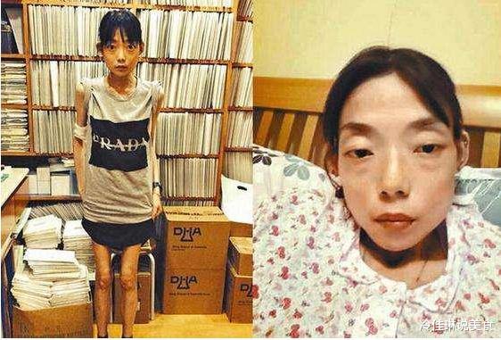 豪门|从名模到“怪物”，被豪门抛弃的伍智恒，42岁牙齿掉光全身瘫痪