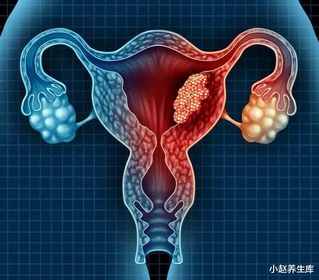 「宫颈癌」一旦内裤出现这种异常，可能是宫颈癌“找上门”，女性要注意！