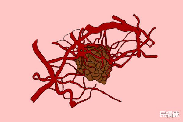 医生|癌症患者能不能吃发物？医生老实说：真正该忌口的是3样食物