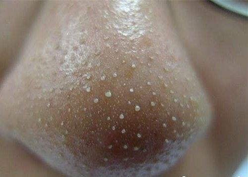 #螨虫#鼻子周围挤出来白点？白点增多什么情况？今天就给大家科普一下！