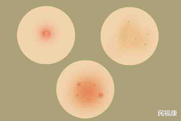 【肝癌】肝不好,全写在脸上,发现不对劲,就要趁早去做检查