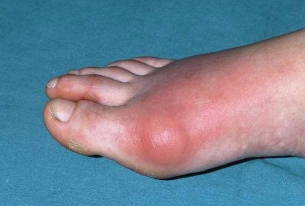 痛风■41岁男子痛风发作，多器官衰竭离世，医生呼吁：2件事趁早远离