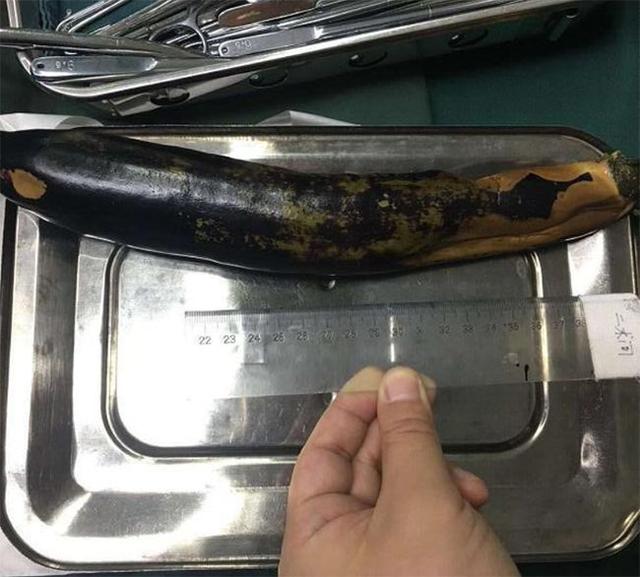 茄子|30厘米的茄子快顶到心脏了，医生也没有办法，直摇头