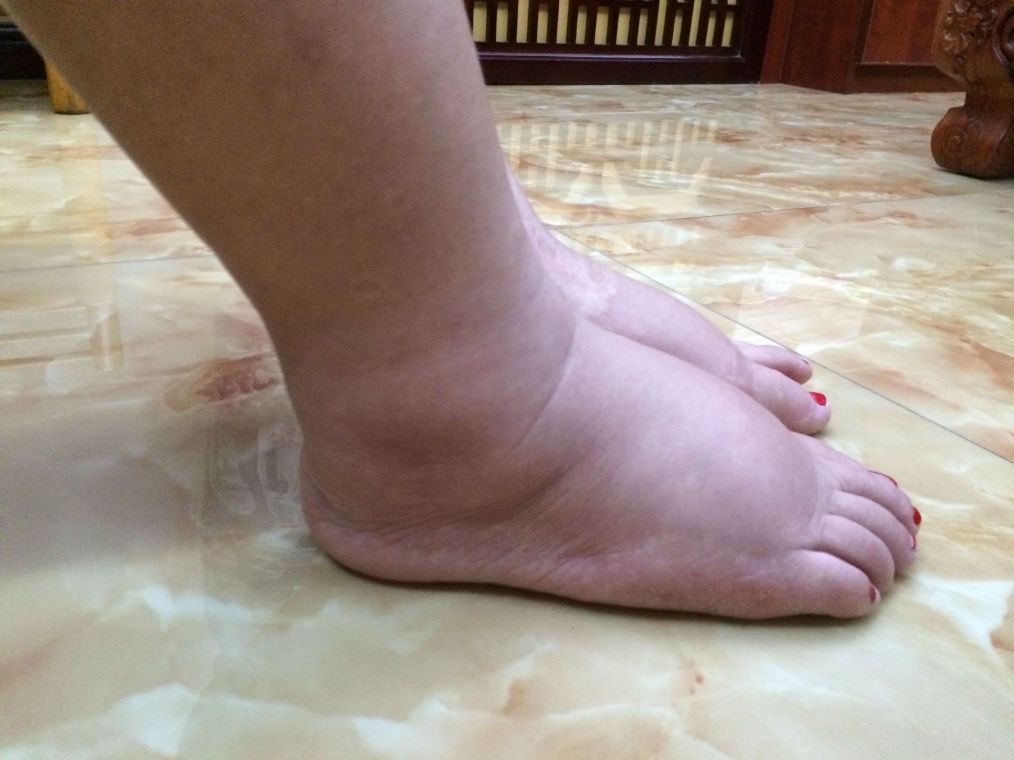 [肝脏]肝硬化发生时，手脚会有3个很明显的异常，需要立即去医院查查肝