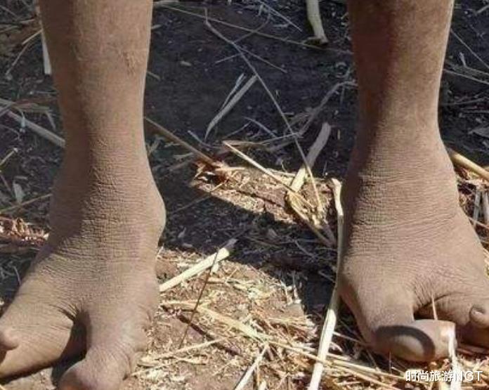 [鸵鸟]非洲的“鸵鸟人”部落，生来只有2个脚趾，专家后来揭开谜底