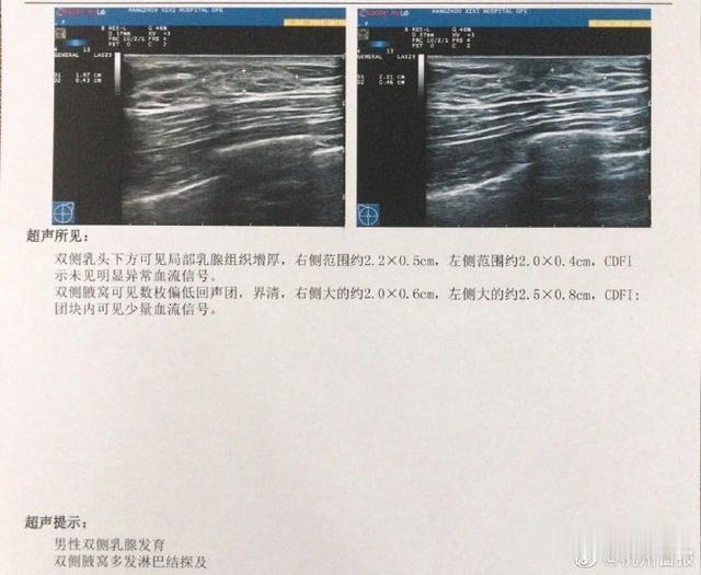 脂肪肝|杭州26岁小伙花万元请私教三个月后乳房发育：我都还没找女朋友