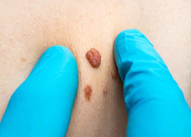 蜘蛛痣|体内有癌,痣先知?医生告诫:这3种痣癌变风险大,尤其要当心