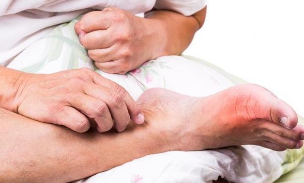 高尿酸血症■尿酸超标，高于420怎么办？医生提醒：这个正确的降尿酸法请收好