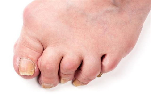 痛风@尿酸一高，睡觉会有哪些症状？你或许不知道，我来告诉你！