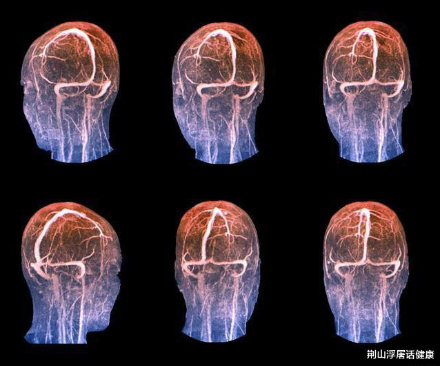 脑梗|57岁男子突然晕倒,脑梗离世,医生:一把年纪,这事早该控制了!