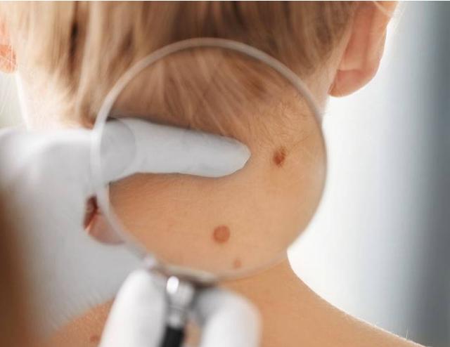 肝癌@肝癌并非毫无信号，身体突然出现“蜘蛛痣”，可能是肝癌在作祟