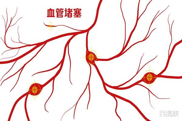 胆固醇|血管堵塞可能是吃出来的，伤血管的4样食物，喜欢也不要多吃