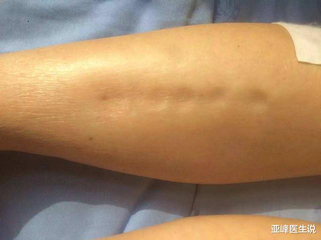 肾炎|肾炎有早期症状吗？肾内科主任：重视三处，不会太晚发现