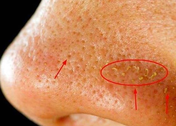「螨虫」鼻子上挤出来一堆白色分泌物？它们是什么？今天就给大家科普一下！
