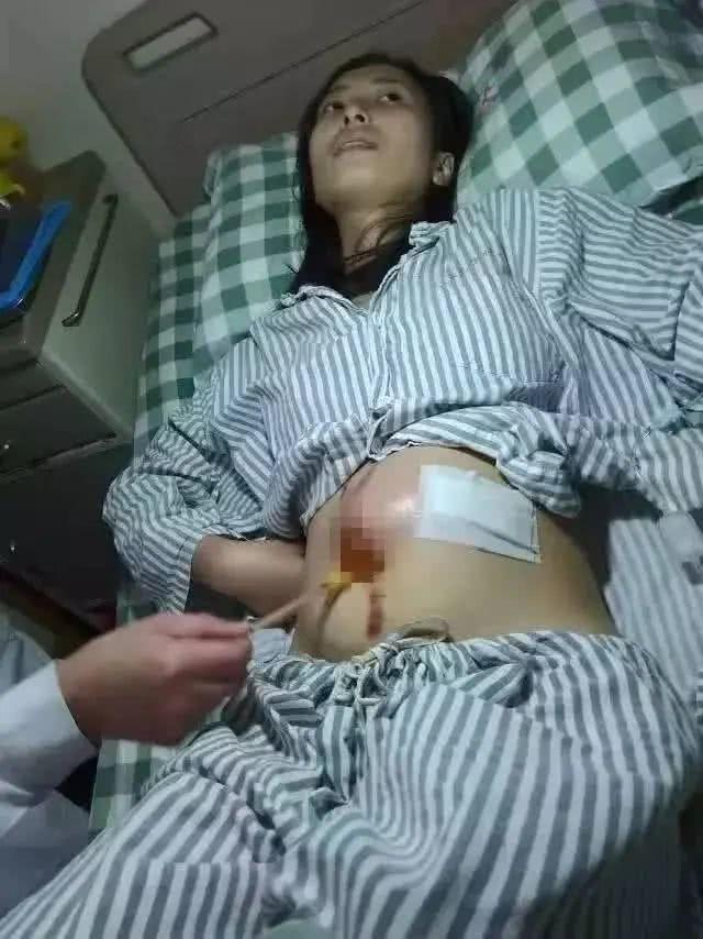 【排便】22岁少女腹大如球，入院就下了病危，父母却痛哭说：不要抢救了