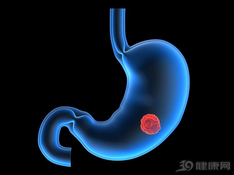胃癌|太后悔！右肩疼了大半年，一查竟是癌！医生：5个症状都是前兆