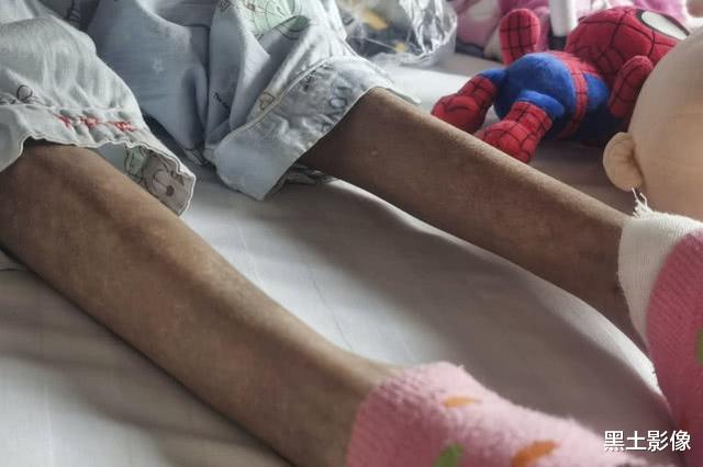 抗癌@7岁“小萝莉”患重症4年样貌大变,今被医生禁食3个月瘦成皮包骨