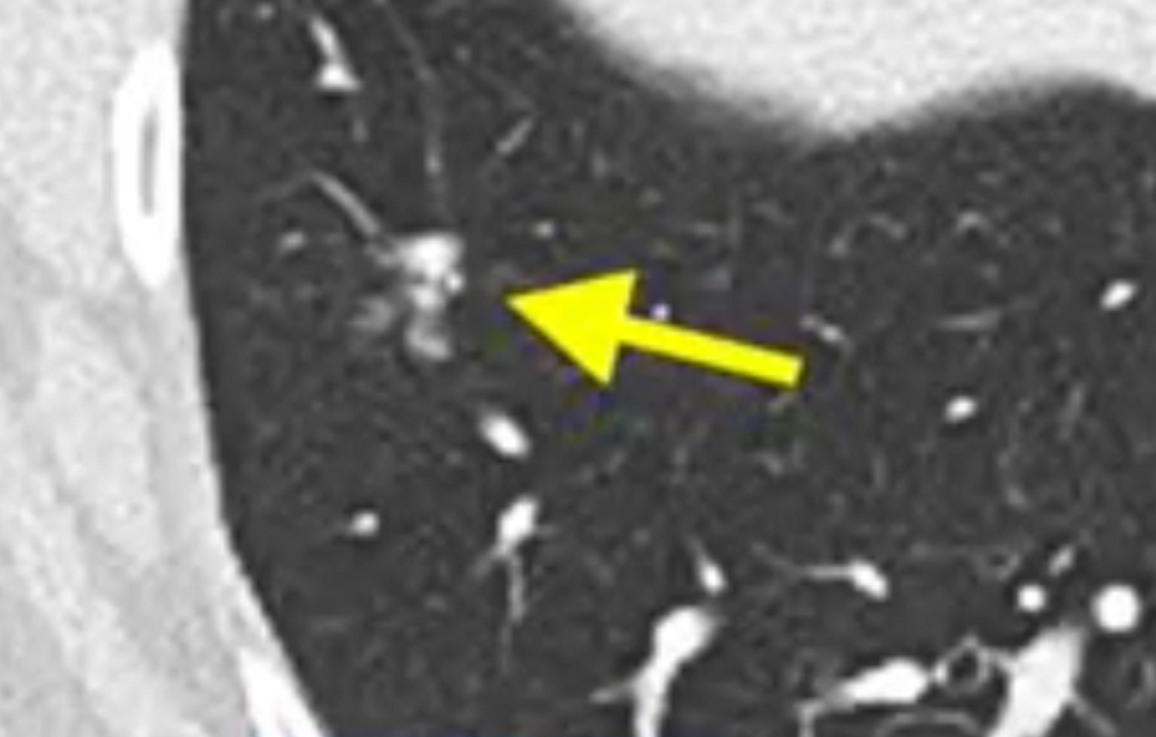 外星人|五类晚期癌症完全缓解!新型免疫疗法有望上市