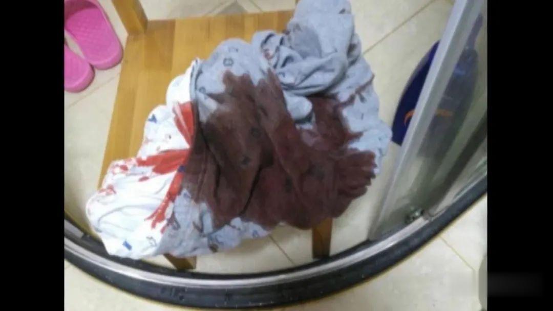 清苑：“血都是飙出来的！”8岁男童半夜血染床单，竟是这个东西掉出来了……