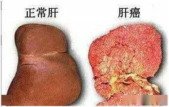 #肝癌#肠道菌群紊乱产生的内毒素是肝癌发生的推手