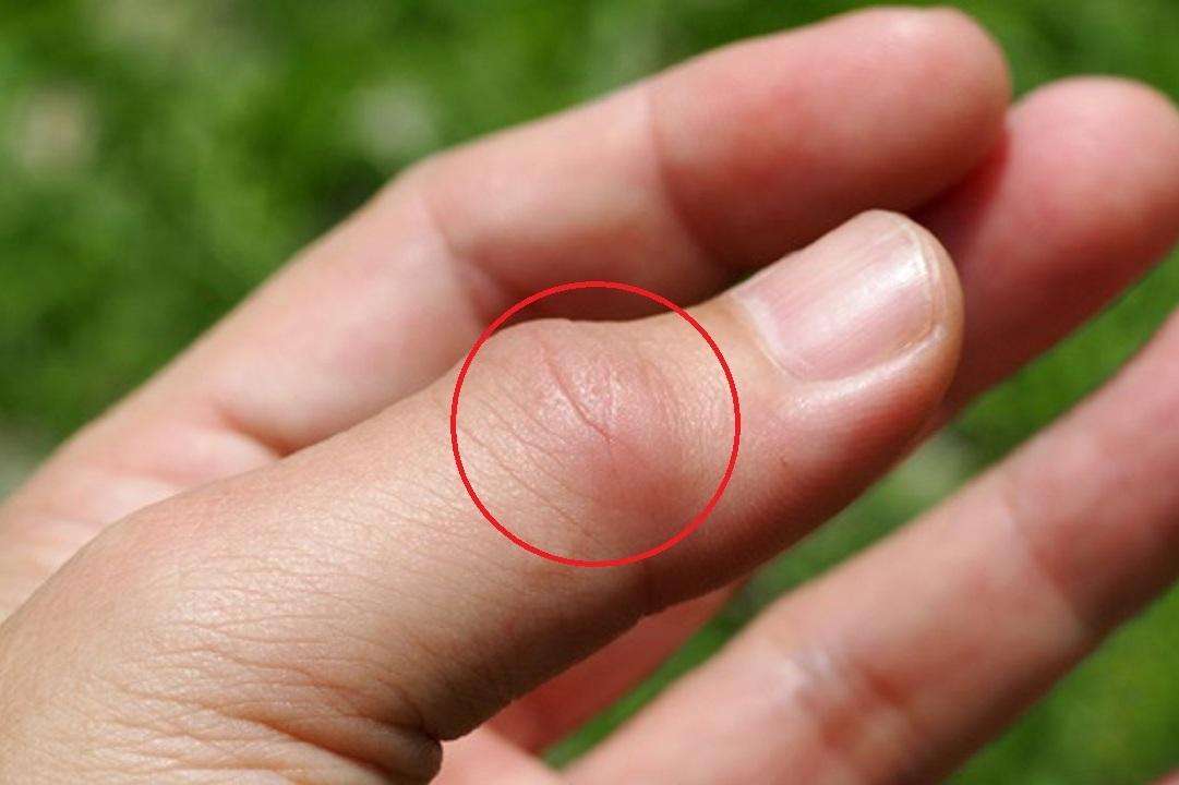 「肝脏」痛风降尿酸你知道碱化尿液有多重要吗?