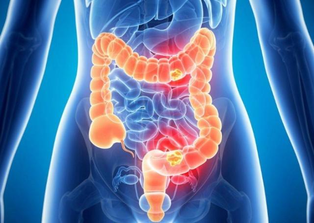 肠癌|肠癌早期，上厕所时或许会露出3个马脚，如果你没有，很幸运