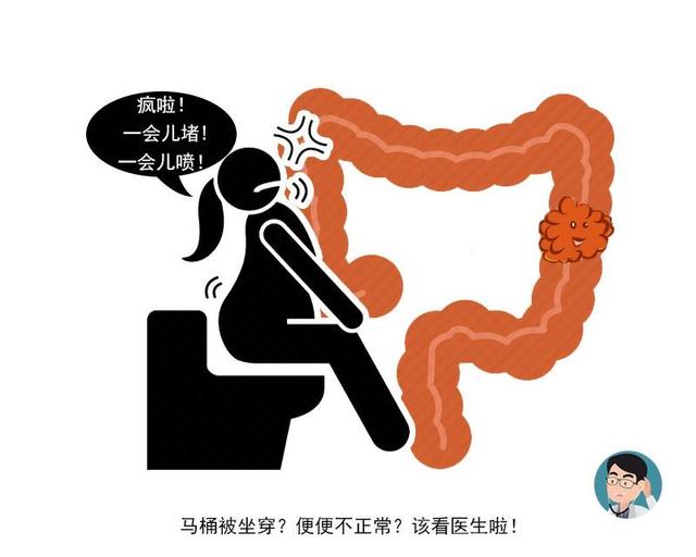 艾灸|肠内有癌，身体通常有4个标志！哪怕占一个，也尽快去医院检查