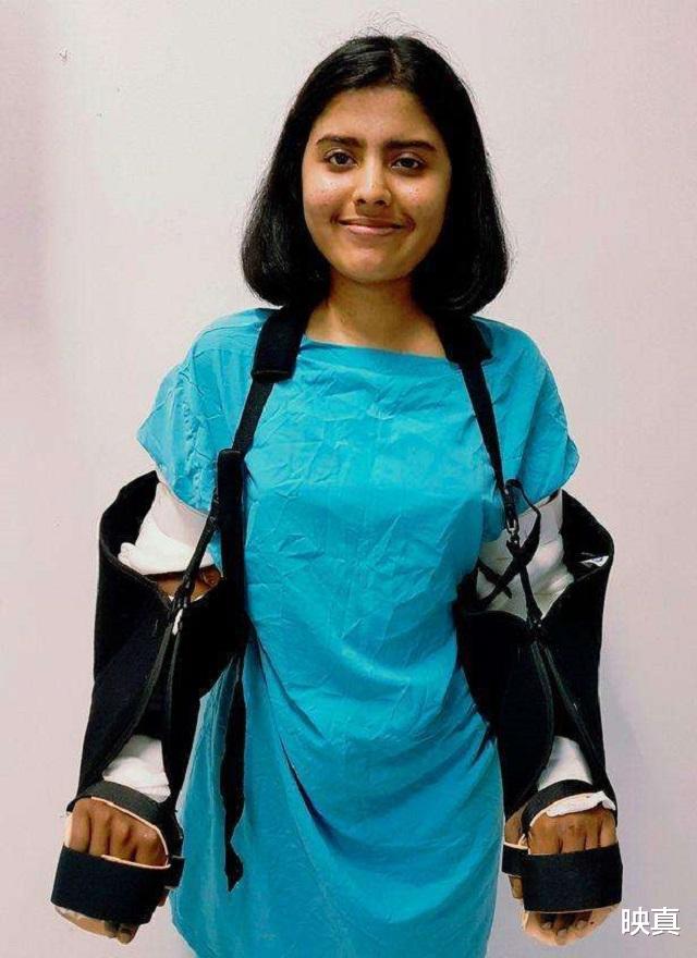 印度女孩因車禍失去雙臂，移植瞭黑人的手臂後，皮膚開始變黑-圖4