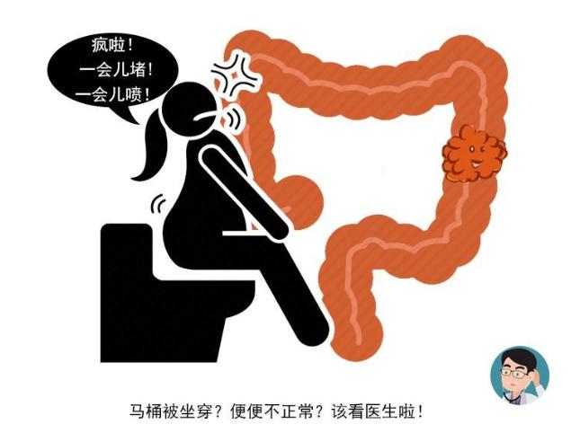 胆固醇|为何肠癌趋势年轻化？医生忠告：符合这6种情况，及时做肠镜