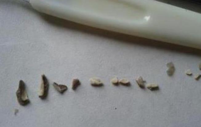 「牙结石」40岁女子口臭严重，医生发现嘴巴里有“石头”，情况很尴尬