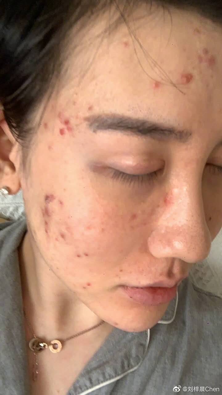 毁容|网红刘梓晨在美国发文：正经历地狱般生活！全脸毁容还被网友“恭喜”