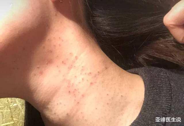 肿瘤|脖子上为何会出现小肉粒?对身体有伤害吗?若是这两种就要注意