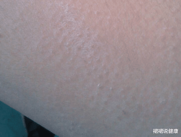 []小腿上长“鳞片”，脚后跟“开裂”，多数人还以为是缺水，治出麻烦