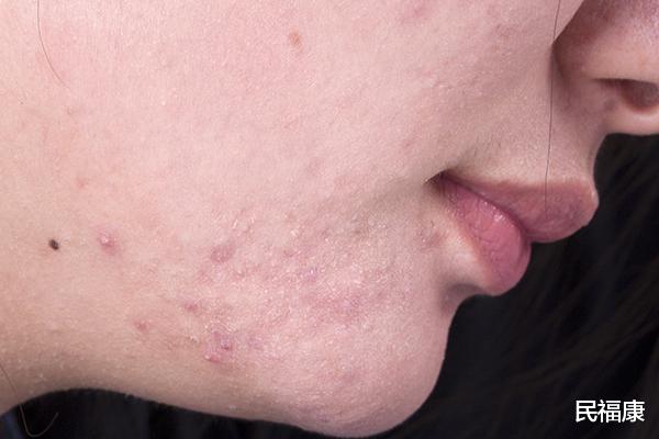 高血脂|肝癌怎么一发现就是晚期？医生：头部出现4种表现，尽快检查肝脏